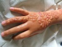 Schwarzes Henna-Tattoo verursacht chemische Verbrennungen bei kleinen Mädchen, die möglicherweise lebenslang Narben haben